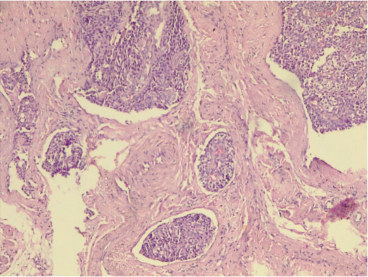 Poorly differentiated squamous cell carcinoma exhibiting lymphovascular invasion of tumoral cells (H&E)