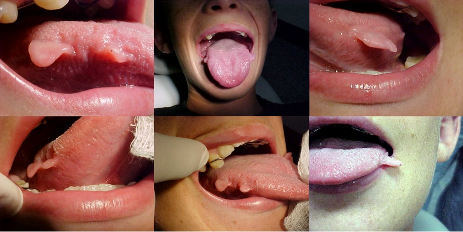 The pFocal fibrous hyperplasia on the lateral border on both sides of the tongue